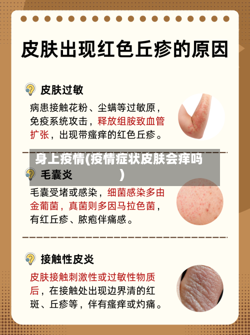 身上疫情(疫情症状皮肤会痒吗)-第2张图片