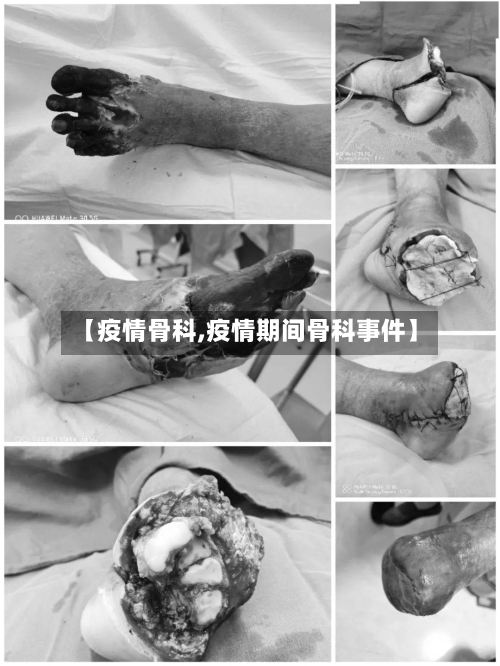 【疫情骨科,疫情期间骨科事件】