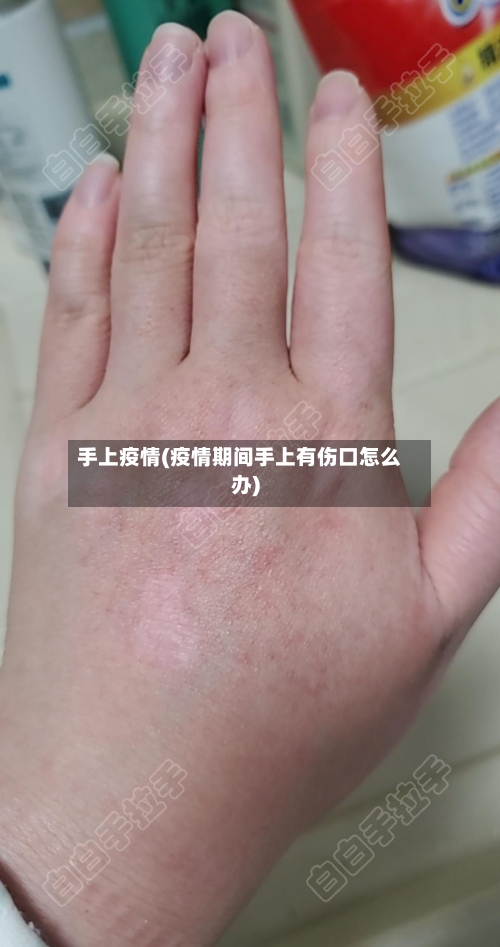 手上疫情(疫情期间手上有伤口怎么办)