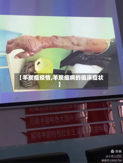 【羊炭疽疫情,羊炭疽病的临床症状】